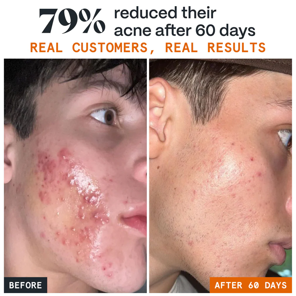 Pimple Stopper Night Balm - Image 15