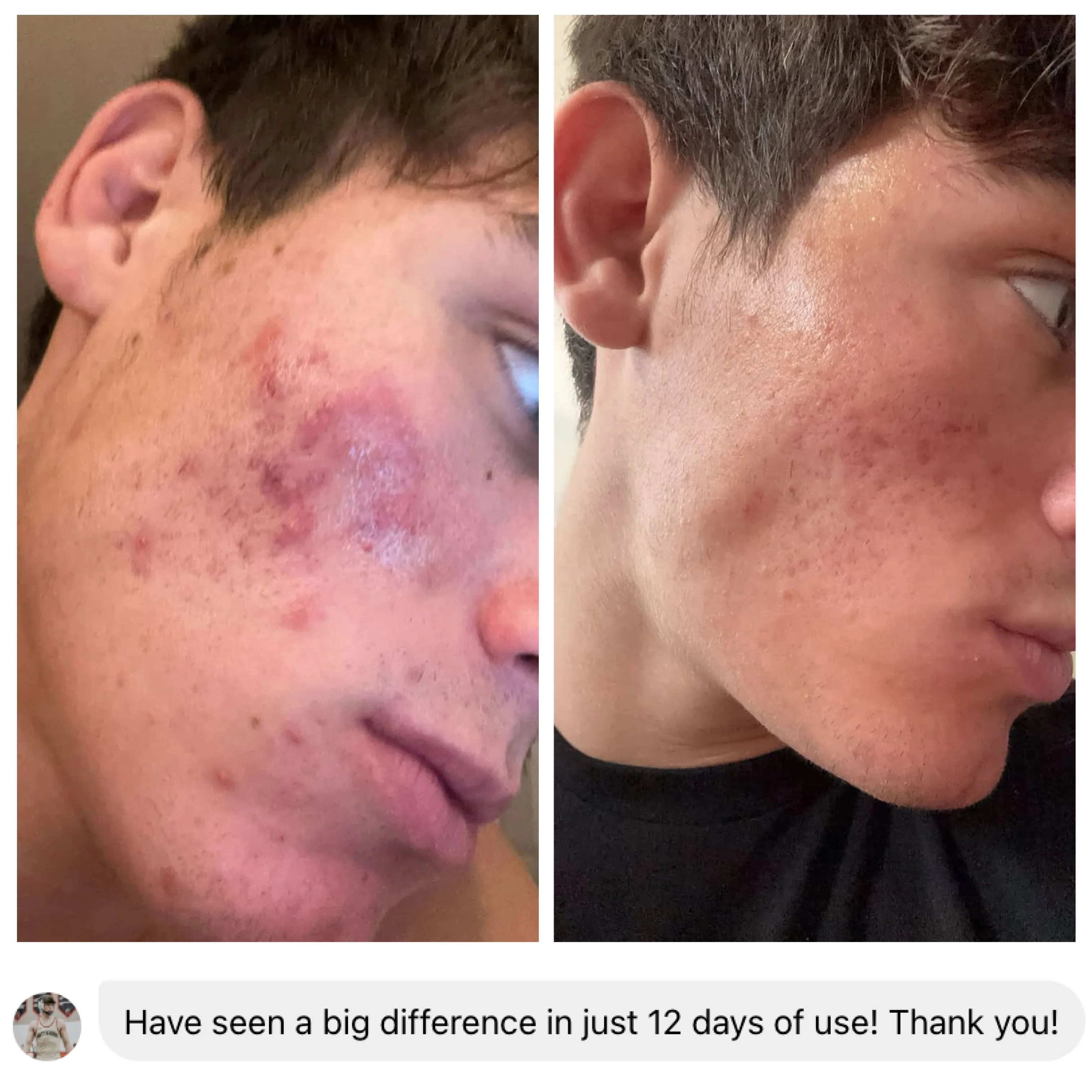 Pimple Scars Balm 2.0 - Image 17