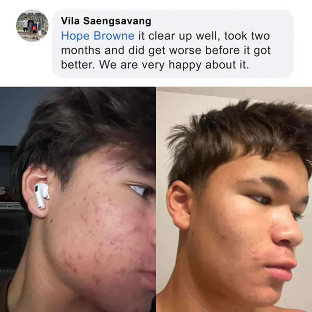 Pimple Scars Balm 2.0 - Image 19