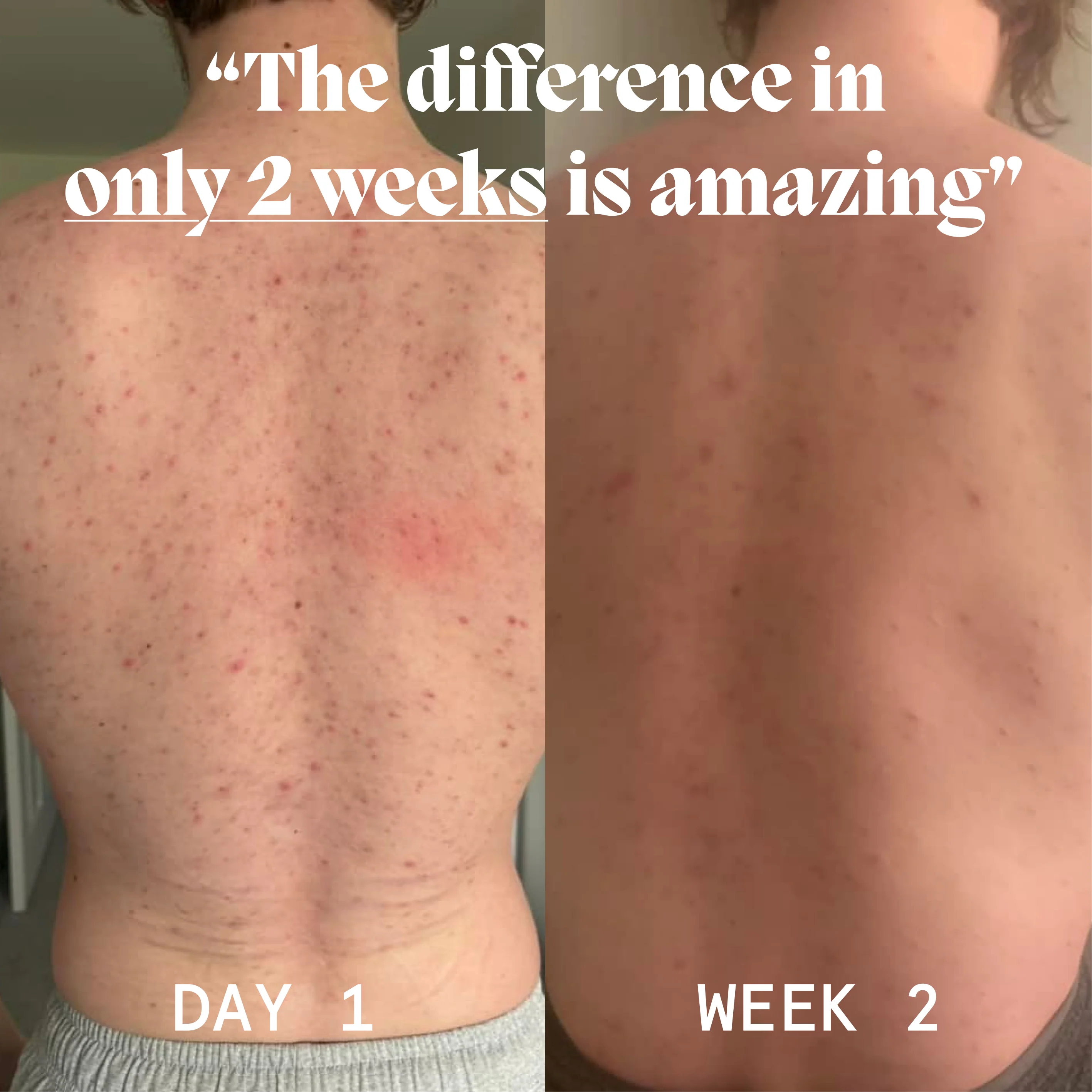 Body Balm for Acne Prone Skin - Image 13