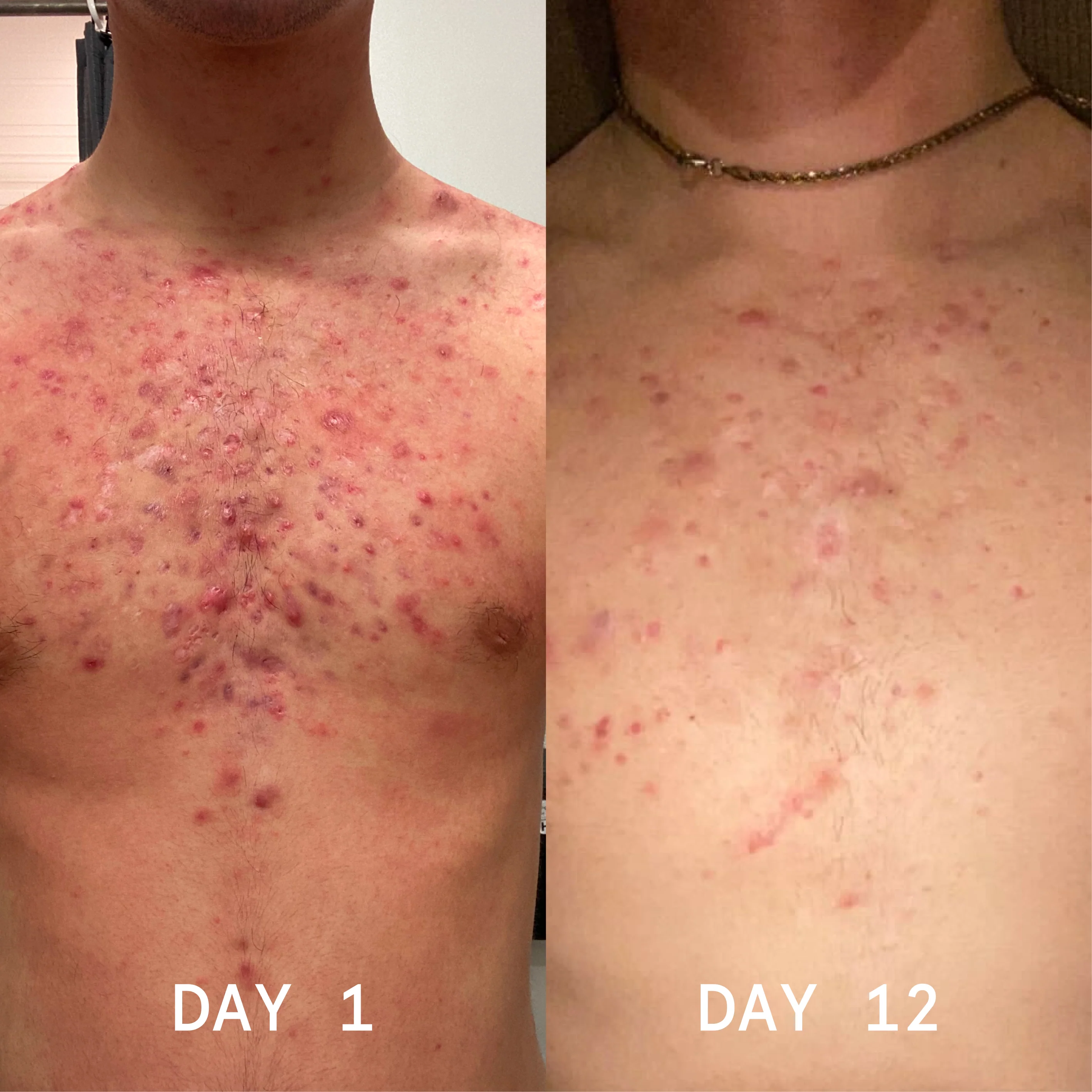 Body Balm for Acne Prone Skin - Image 3
